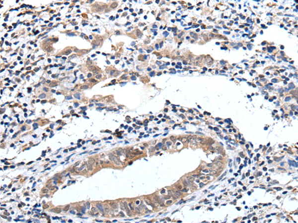 Immunohistochemistry of paraffin-embedded Human cervical cancer tissue  using ELMO1 Polyclonal Antibody at dilution of 1:40(×200)
