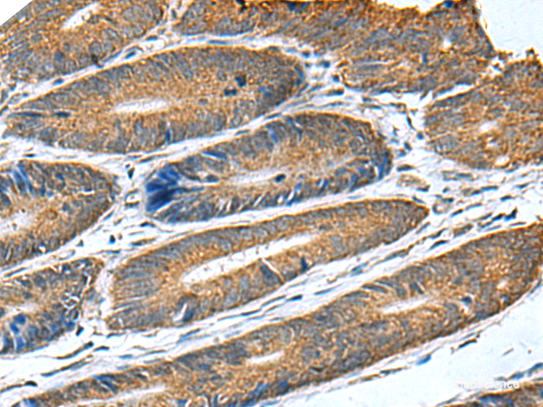 Immunohistochemistry of paraffin-embedded Human colorectal cancer tissue  using HSD11B1 Polyclonal Antibody at dilution of 1:70(×200)