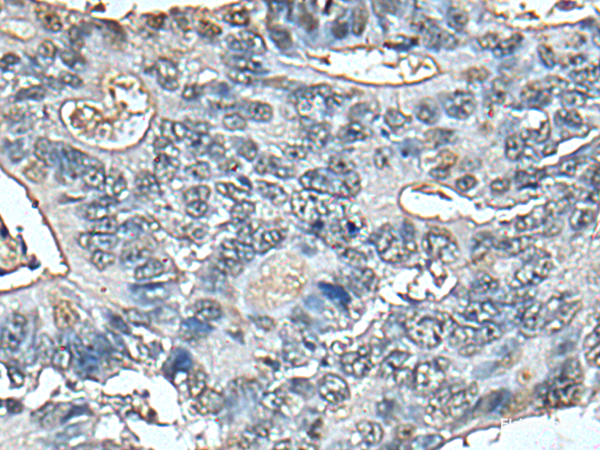 Immunohistochemistry of paraffin-embedded Human colorectal cancer tissue  using STRADA Polyclonal Antibody at dilution of 1:85(×200)