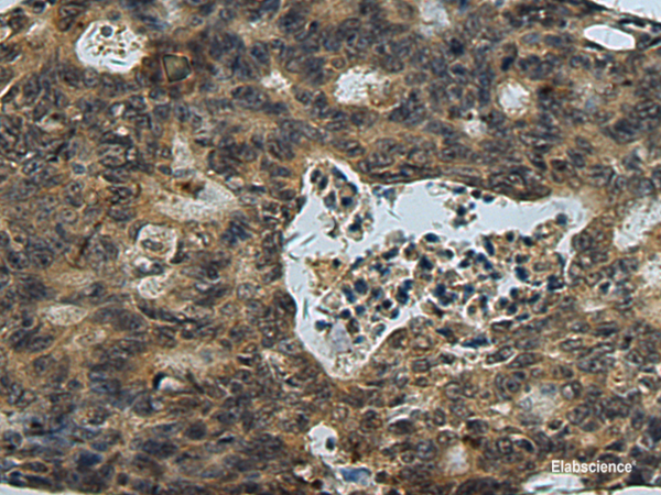 Immunohistochemistry of paraffin-embedded Human colorectal cancer tissue  using PLTP Polyclonal Antibody at dilution of 1:60(×200)