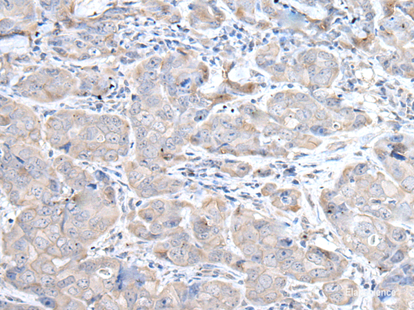 Immunohistochemistry of paraffin-embedded Human breast cancer tissue  using RASA1 Polyclonal Antibody at dilution of 1:45(×200)
