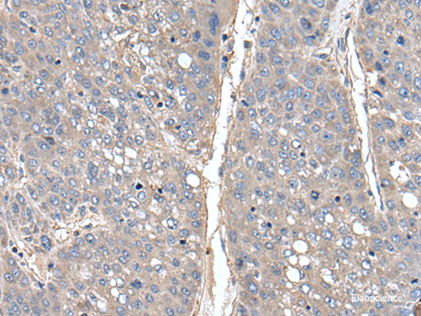 Immunohistochemistry of paraffin-embedded Human liver cancer tissue  using THAP10 Polyclonal Antibody at dilution of 1:40(×200)
