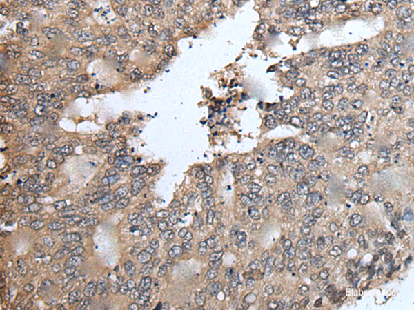 Immunohistochemistry of paraffin-embedded Human colorectal cancer tissue  using TRIM23 Polyclonal Antibody at dilution of 1:55(×200)
