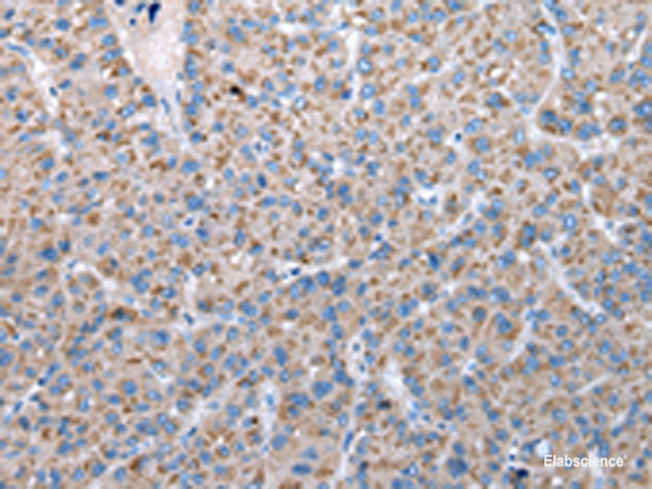 Immunohistochemistry of paraffin-embedded Human liver cancer tissue  using FKBPL Polyclonal Antibody at dilution of 1:50(×200)