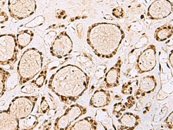 Immunohistochemistry of paraffin-embedded Human thyroid cancer tissue  using XRCC4 Polyclonal Antibody at dilution of 1:60(×200)