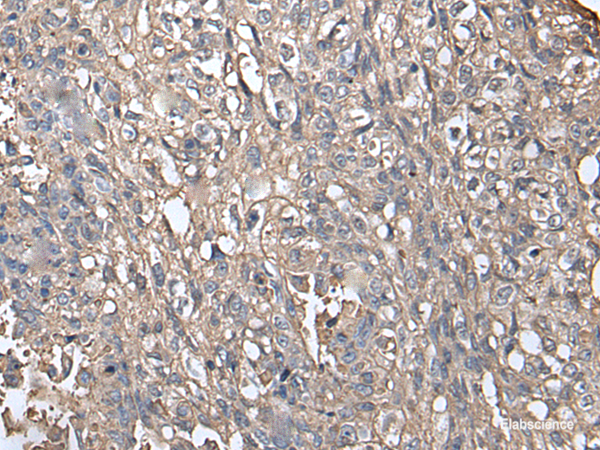 Immunohistochemistry of paraffin-embedded Human lung cancer tissue  using NDUFB5 Polyclonal Antibody at dilution of 1:45(×200)