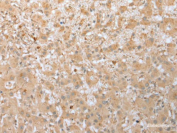 Immunohistochemistry of paraffin-embedded Human liver cancer tissue  using FNDC3B Polyclonal Antibody at dilution of 1:45(×200)