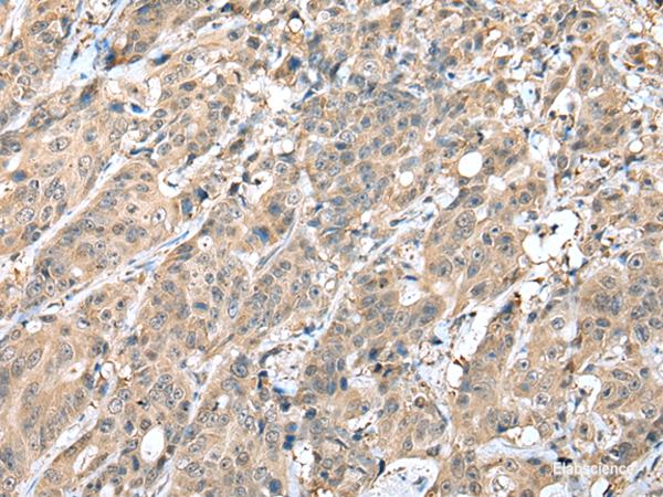 Immunohistochemistry of paraffin-embedded Human colorectal cancer tissue  using HIF1A Polyclonal Antibody at dilution of 1:45(×200)