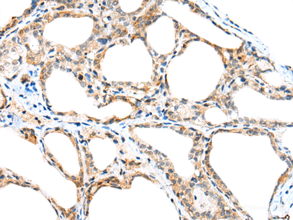 Immunohistochemistry of paraffin-embedded Human thyroid cancer tissue  using SPACA3 Polyclonal Antibody at dilution of 1:45(×200)