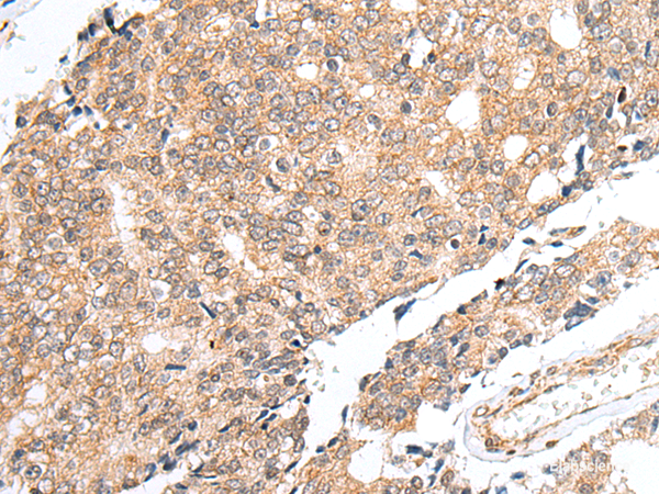 Immunohistochemistry of paraffin-embedded Human prost at e cancer tissue  using PRELID1 Polyclonal Antibody at dilution of 1:40(×200)