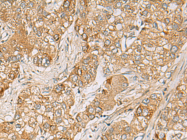 Immunohistochemistry of paraffin-embedded Human liver cancer tissue  using LRRC28 Polyclonal Antibody at dilution of 1:80(×200)