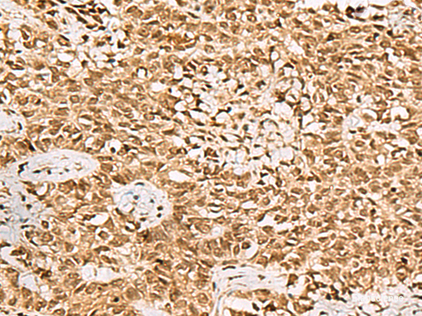 Immunohistochemistry of paraffin-embedded Human ovarian cancer tissue  using LRRC2 Polyclonal Antibody at dilution of 1:70(×200)
