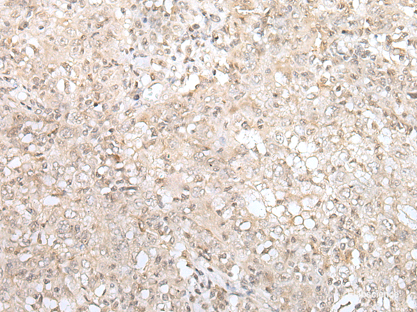 Immunohistochemistry of paraffin-embedded Human esophagus cancer tissue  using ZNF263 Polyclonal Antibody at dilution of 1:40(×200)