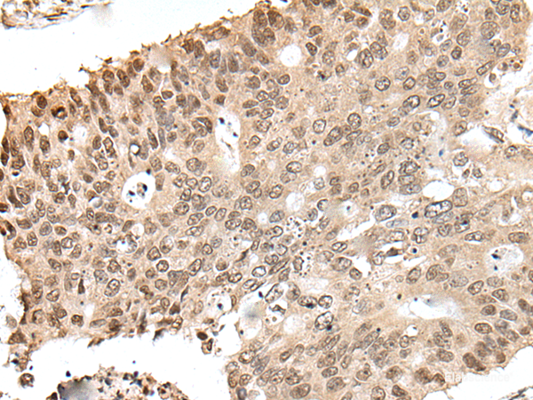 Immunohistochemistry of paraffin-embedded Human colorectal cancer tissue  using ZNF410 Polyclonal Antibody at dilution of 1:40(×200)