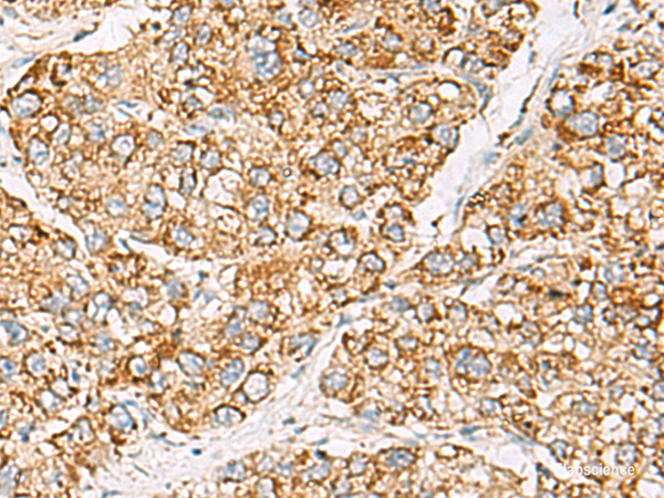 Immunohistochemistry of paraffin-embedded Human liver cancer tissue  using ZPBP2 Polyclonal Antibody at dilution of 1:50(×200)
