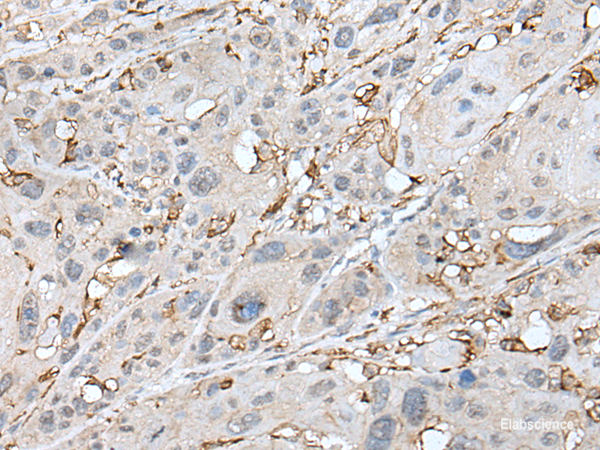 Immunohistochemistry of paraffin-embedded Human esophagus cancer tissue  using CD14 Polyclonal Antibody at dilution of 1:40(×200)