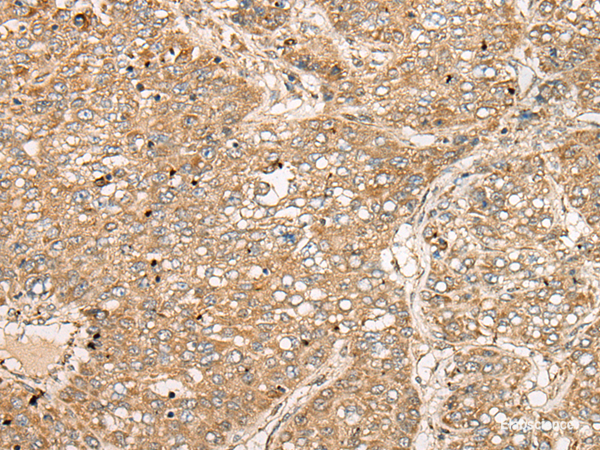 Immunohistochemistry of paraffin-embedded Human liver cancer tissue  using TDGF1 Polyclonal Antibody at dilution of 1:50(×200)
