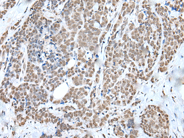Immunohistochemistry of paraffin-embedded Human thyroid cancer tissue  using WTAP Polyclonal Antibody at dilution of 1:35(×200)