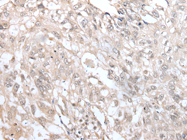 Immunohistochemistry of paraffin-embedded Human lung cancer tissue  using VRK3 Polyclonal Antibody at dilution of 1:45(×200)