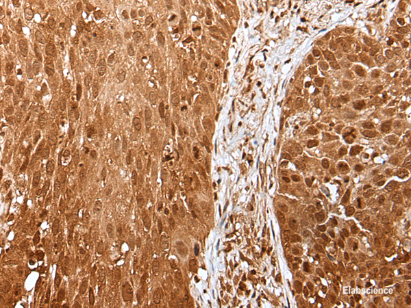 Immunohistochemistry of paraffin-embedded Human lung cancer tissue  using UBA7 Polyclonal Antibody at dilution of 1:35(×200)