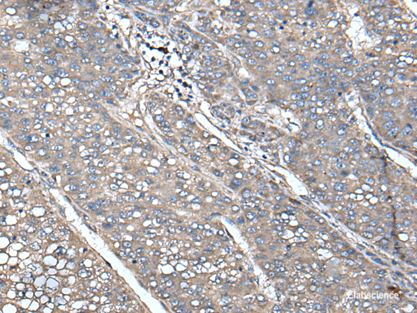 Immunohistochemistry of paraffin-embedded Human liver cancer tissue  using UNC13B Polyclonal Antibody at dilution of 1:85(×200)
