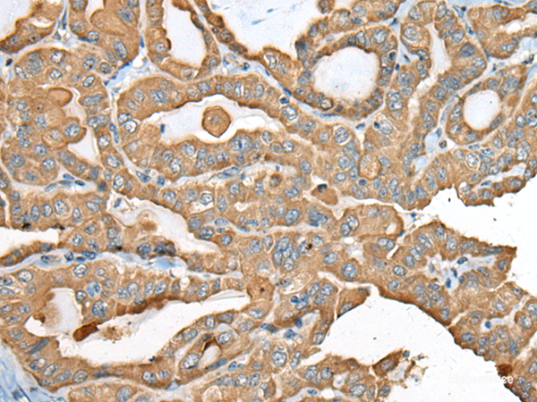 Immunohistochemistry of paraffin-embedded Human thyroid cancer tissue  using USP12 Polyclonal Antibody at dilution of 1:35(×200)