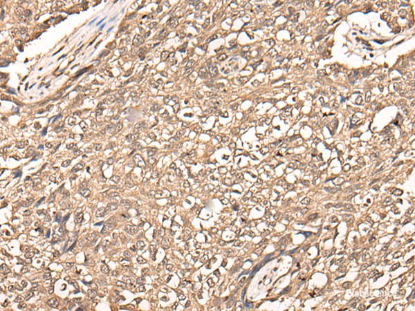 Immunohistochemistry of paraffin-embedded Human lung cancer tissue  using USP21 Polyclonal Antibody at dilution of 1:50(×200)