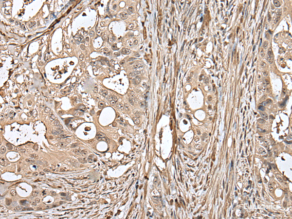 Immunohistochemistry of paraffin-embedded Human colorectal cancer tissue  using UTP3 Polyclonal Antibody at dilution of 1:50(×200)