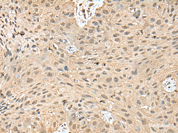 Immunohistochemistry of paraffin-embedded Human lung cancer tissue  using ATXN3 Polyclonal Antibody at dilution of 1:50(×200)