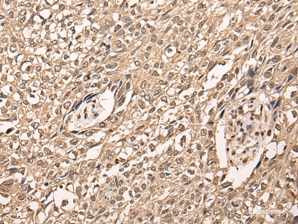 Immunohistochemistry of paraffin-embedded Human lung cancer tissue  using ATF7 Polyclonal Antibody at dilution of 1:40(×200)