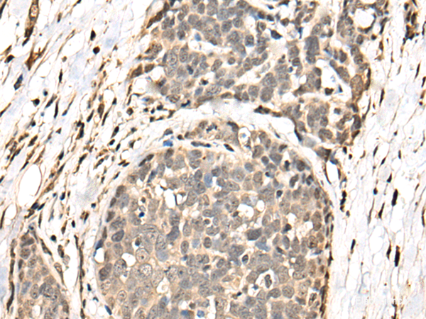 Immunohistochemistry of paraffin-embedded Human thyroid cancer tissue  using BATF Polyclonal Antibody at dilution of 1:40(×200)