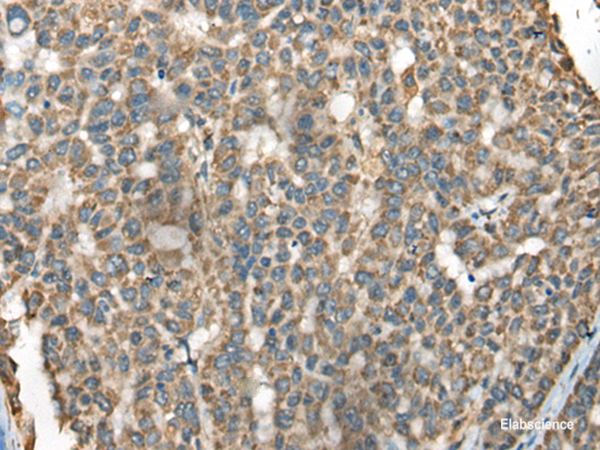 Immunohistochemistry of paraffin-embedded Human liver cancer tissue  using BLNK Polyclonal Antibody at dilution of 1:65(×200)