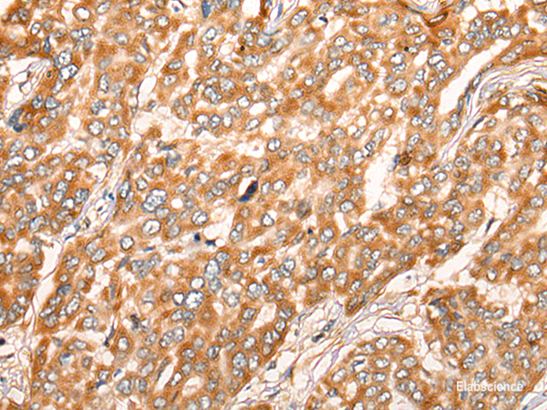Immunohistochemistry of paraffin-embedded Human liver cancer tissue  using ZMYND10 Polyclonal Antibody at dilution of 1:35(×200)