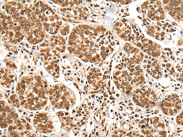 Immunohistochemistry of paraffin-embedded Human esophagus cancer tissue  using BRSK1 Polyclonal Antibody at dilution of 1:95(×200)