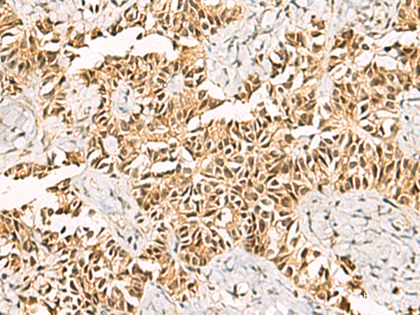 Immunohistochemistry of paraffin-embedded Human ovarian cancer tissue  using LRIF1 Polyclonal Antibody at dilution of 1:70(×200)