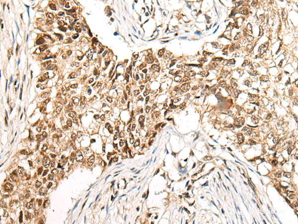 Immunohistochemistry of paraffin-embedded Human lung cancer tissue  using CCDC181 Polyclonal Antibody at dilution of 1:50(×200)