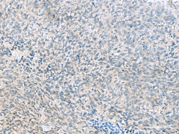 Immunohistochemistry of paraffin-embedded Human cervical cancer tissue  using C1orf112 Polyclonal Antibody at dilution of 1:55(×200)