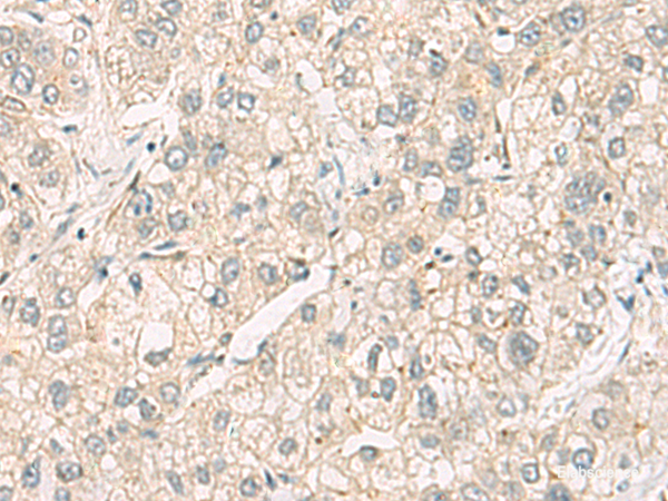Immunohistochemistry of paraffin-embedded Human liver cancer tissue  using C3orf38 Polyclonal Antibody at dilution of 1:95(×200)
