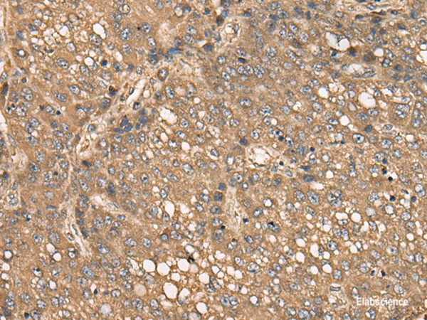 Immunohistochemistry of paraffin-embedded Human liver cancer tissue  using C4BPB Polyclonal Antibody at dilution of 1:35(×200)
