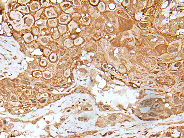 Immunohistochemistry of paraffin-embedded Human esophagus cancer tissue  using IL6ST Polyclonal Antibody at dilution of 1:40(×200)