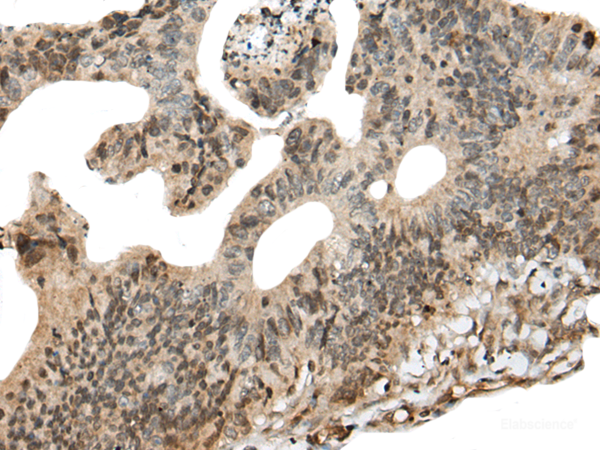 Immunohistochemistry of paraffin-embedded Human colorectal cancer tissue  using CALML5 Polyclonal Antibody at dilution of 1:90(×200)