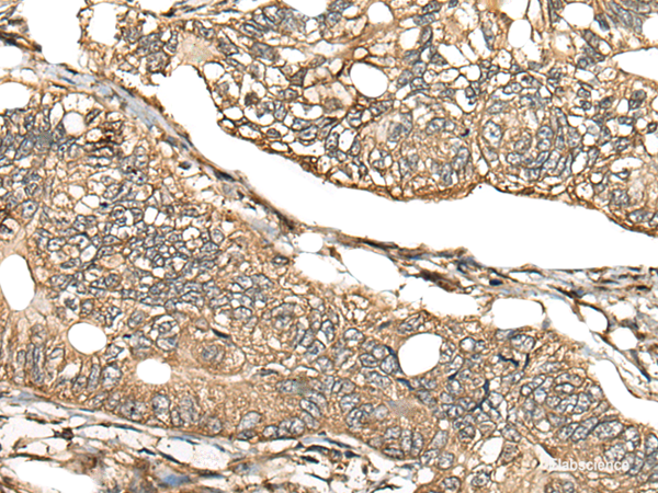 Immunohistochemistry of paraffin-embedded Human gastric cancer tissue  using CA11 Polyclonal Antibody at dilution of 1:30(×200)