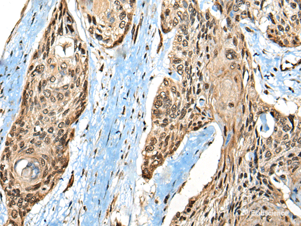 Immunohistochemistry of paraffin-embedded Human esophagus cancer tissue  using CASK Polyclonal Antibody at dilution of 1:65(×200)