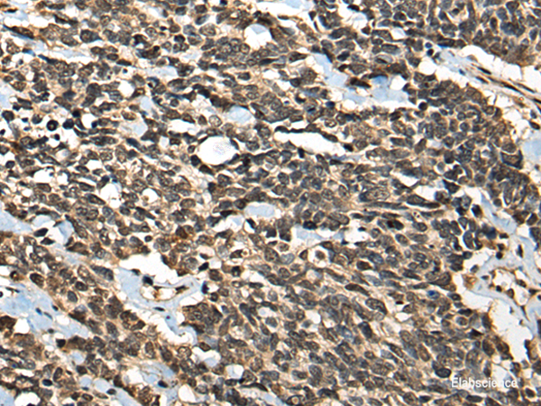 Immunohistochemistry of paraffin-embedded Human lung cancer tissue  using MICU1 Polyclonal Antibody at dilution of 1:35(×200)