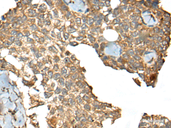 Immunohistochemistry of paraffin-embedded Human ovarian cancer tissue  using CCDC113 Polyclonal Antibody at dilution of 1:35(×200)