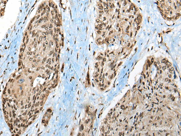 Immunohistochemistry of paraffin-embedded Human esophagus cancer tissue  using CCDC12 Polyclonal Antibody at dilution of 1:50(×200)