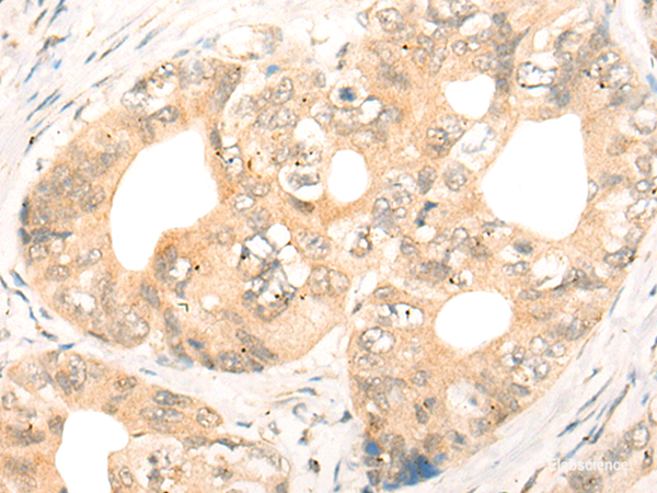 Immunohistochemistry of paraffin-embedded Human gastric cancer tissue  using CD86 Polyclonal Antibody at dilution of 1:55(×200)
