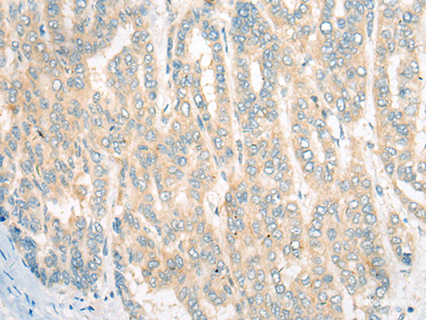 Immunohistochemistry of paraffin-embedded Human liver cancer tissue  using CDKAL1 Polyclonal Antibody at dilution of 1:60(×200)
