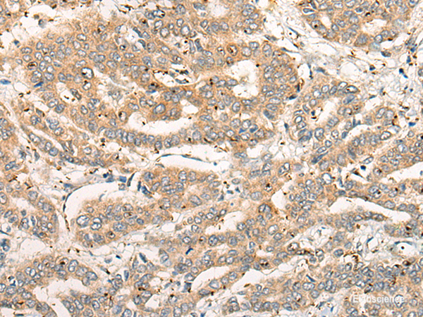 Immunohistochemistry of paraffin-embedded Human liver cancer tissue  using CPNE4 Polyclonal Antibody at dilution of 1:40(×200)
