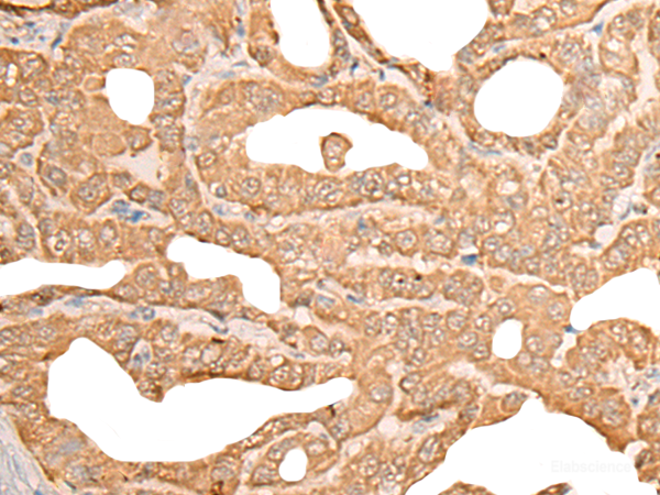Immunohistochemistry of paraffin-embedded Human thyroid cancer tissue  using CUTA Polyclonal Antibody at dilution of 1:45(×200)